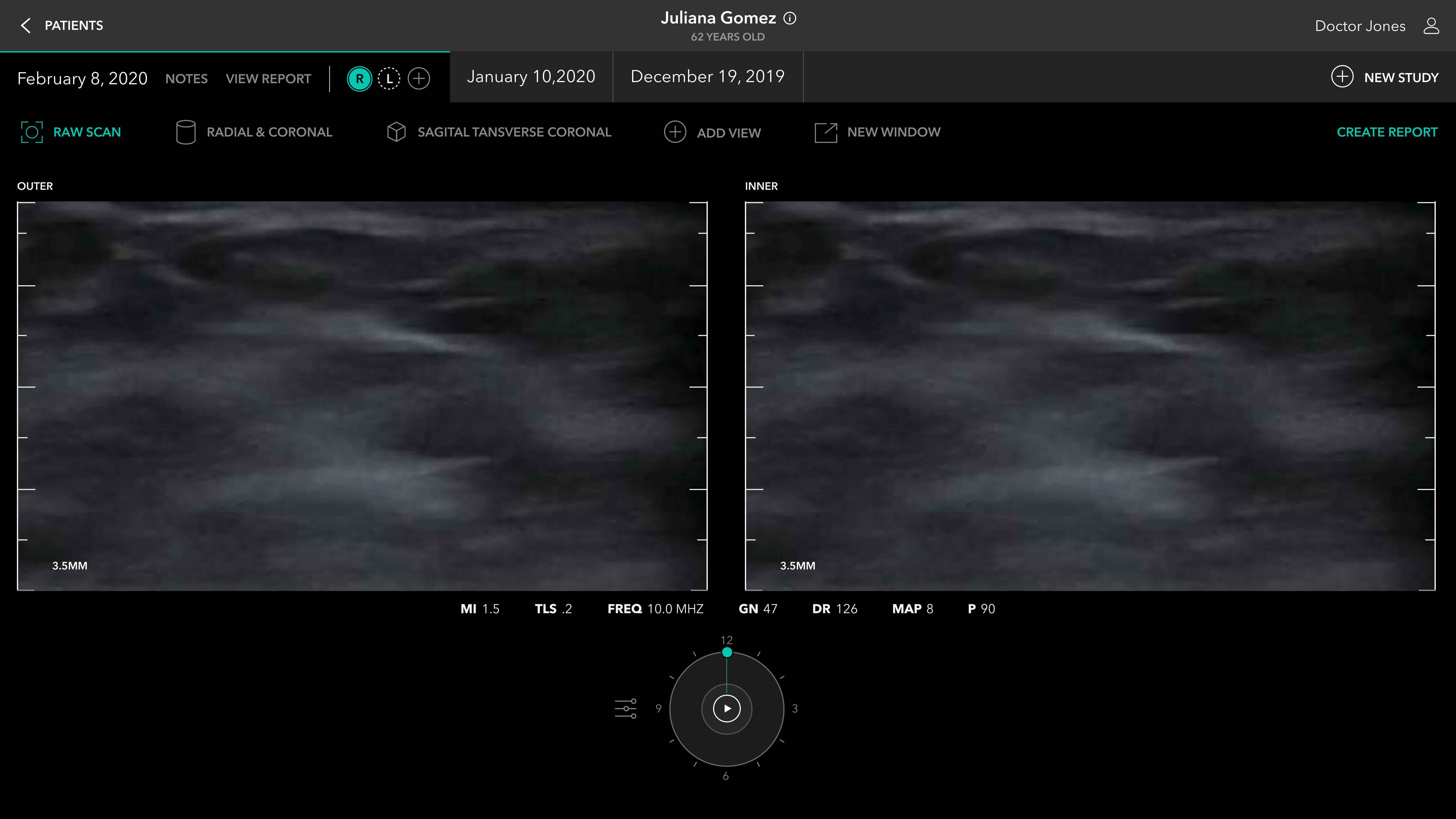 iSono Health — Touchless Breast Cancer Screening UI screen 5
